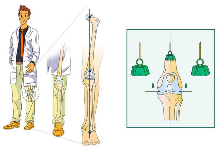 L'axe biomécanique du genou - Dr Mylle, chirurgien orthopédiste à Paris
