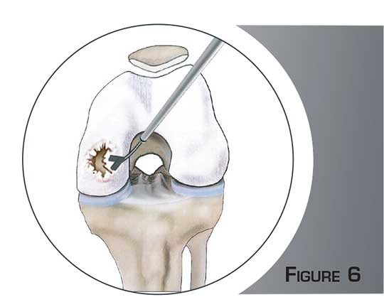 La chirurgie cartilagineuse - Dr Mylle, chirurgien orthopédiste à Paris
