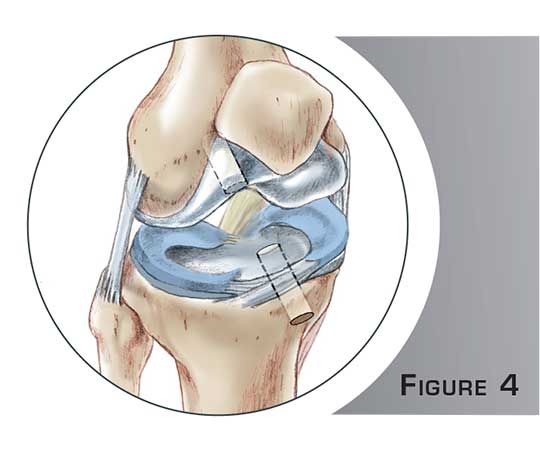 Ligamentoplastie du genou - Dr Mylle, chirurgien orthopédiste à Paris