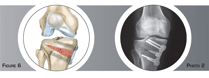 Ostéomie tibiale de valgisation - Dr Mylle, chirurgien orthopédiste à Paris