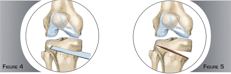 Ostéomie tibiale de valgisation - Dr Mylle, chirurgien orthopédiste à Paris