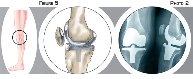 Prothèse totale du genou - Dr Mylle, chirurgien orthopédiste à Paris