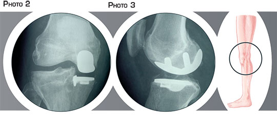 Prothèse unicompartimentale du genou - Dr Mylle, chirurgien orthopédiste à Paris