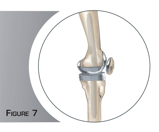 Reprise d'une prothèse du genou - Dr Mylle, chirurgien orthopédiste Paris