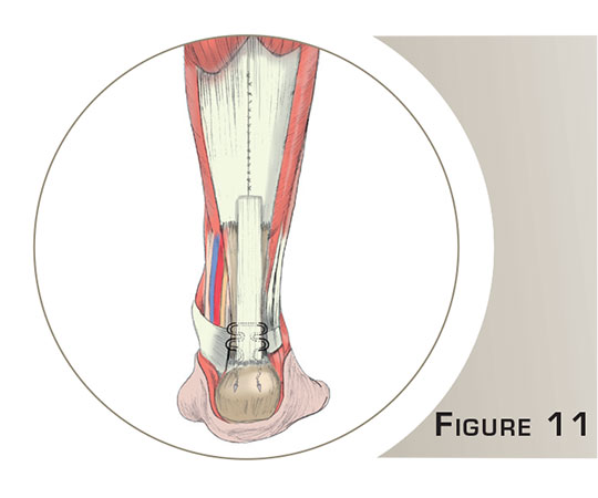 Rupture du tendon d'Achille - Dr Mylle, Paris